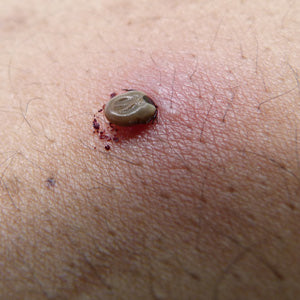 Protecting against and removing ticks